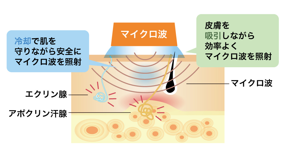 神戸市垂水区でわきが・腋窩多汗症の治療を行うつかもと形成外科・創傷クリニックのワキガ治療の画像