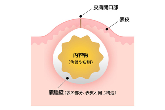 神戸で粉瘤の治療・手術の細かい治療イラスト