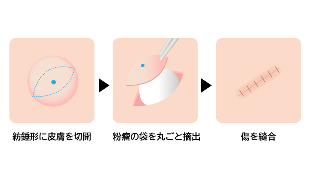 神戸で粉瘤の治療・手術の術式イラスト