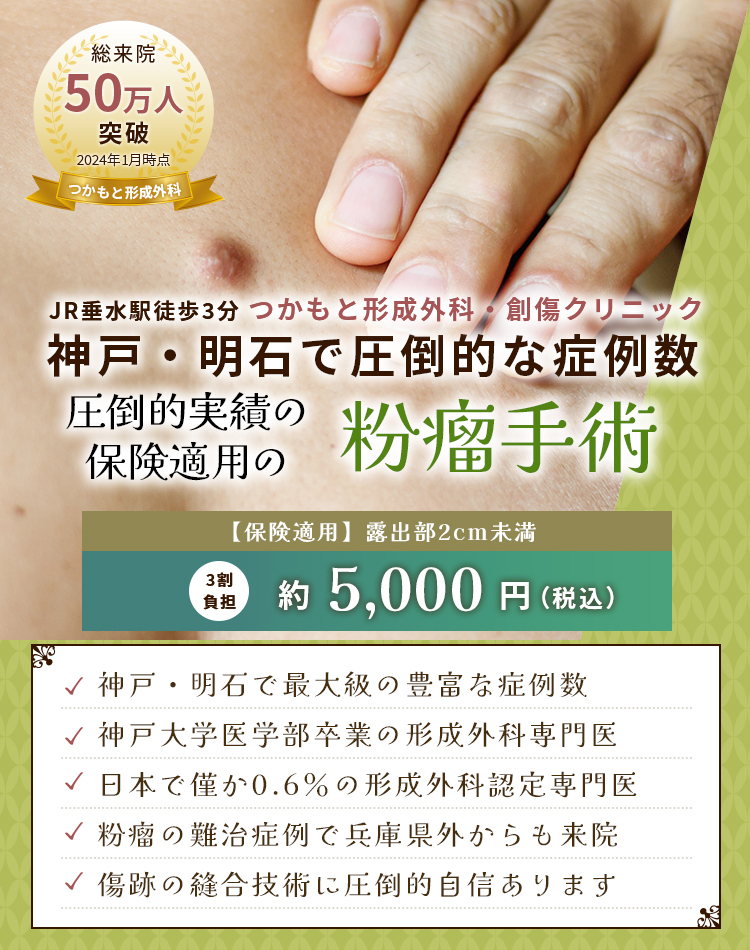 神戸で粉瘤の治療・手術のイメージ画像