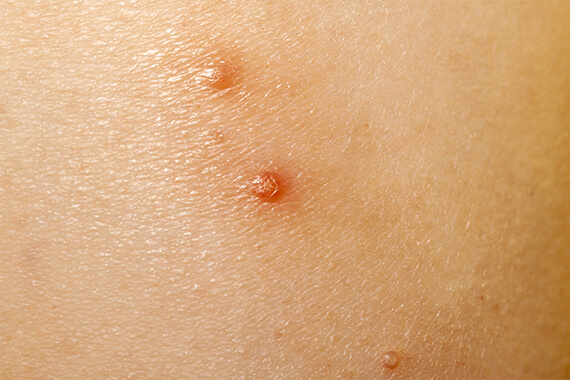 指にできたできものの画像