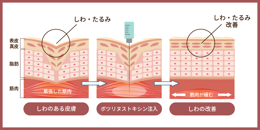 ボツリヌストキシンの仕組み解説図