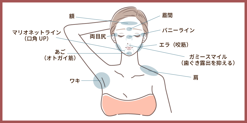 ボツリヌストキシン注射に関するイラスト