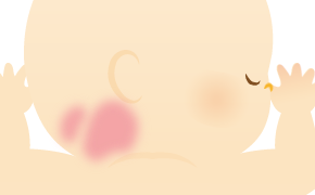ウンナ母斑のイラスト