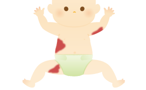単純性血管腫のイラスト