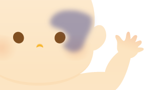 太田母斑のイラスト
