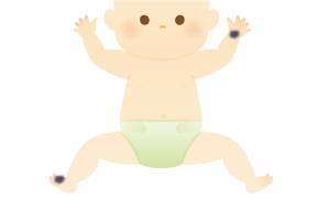青色母斑のイラスト