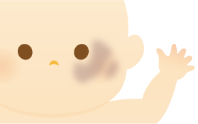 遅発性太田母斑のイラスト