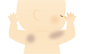 ベッカー母斑のイラスト