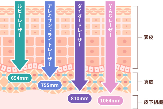 医療脱毛におけるレーザー解説図