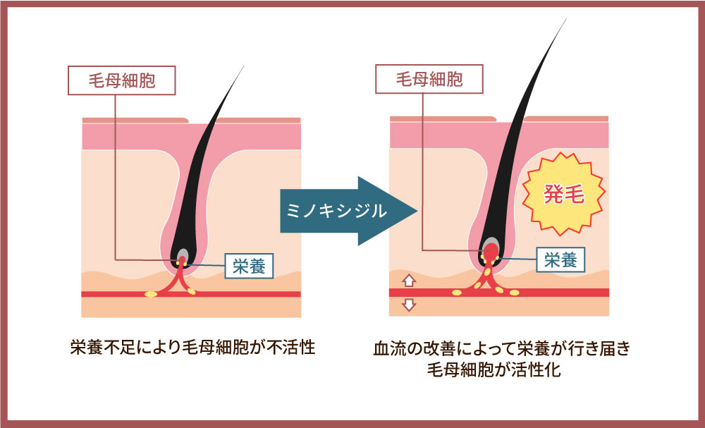 FAGAの原因とは