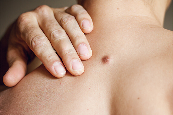 できものの画像