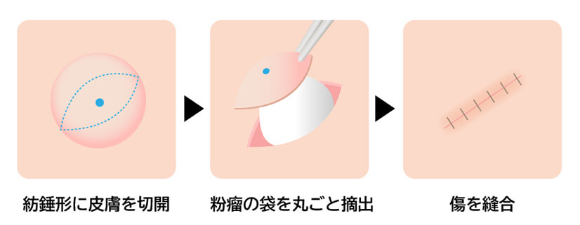 外科的摘出手術（根治治療）の詳細画像