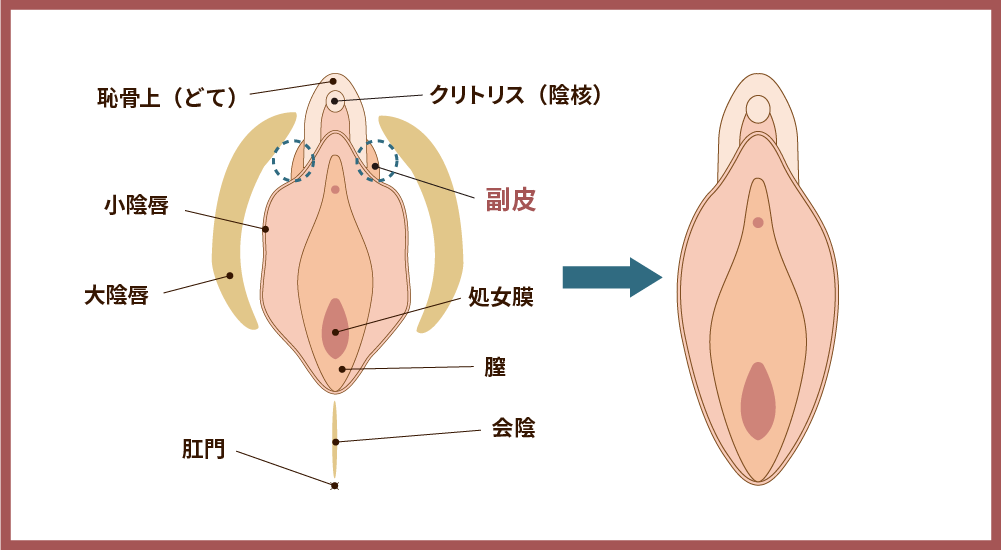 副皮除去術の解説図