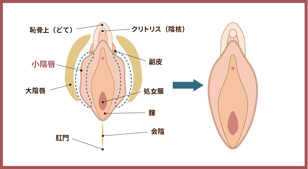 小陰唇縮小術の解説図