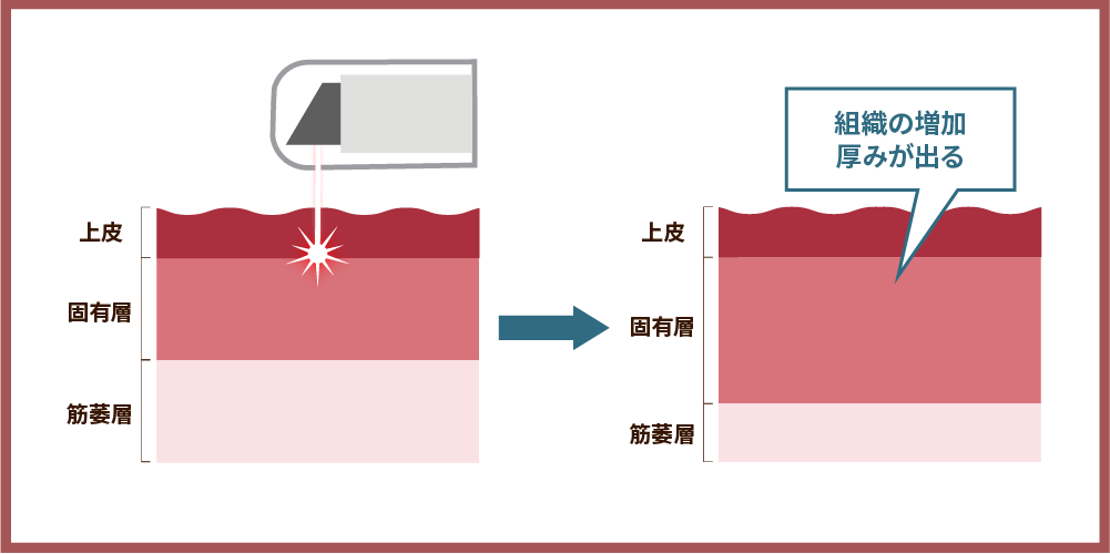 デリケートゾーン引き締めレーザーの解説図