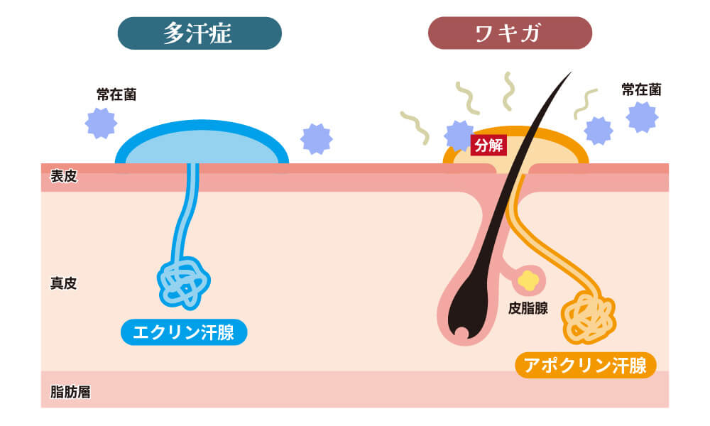 汗腺多汗症とワキガの違いのイラスト