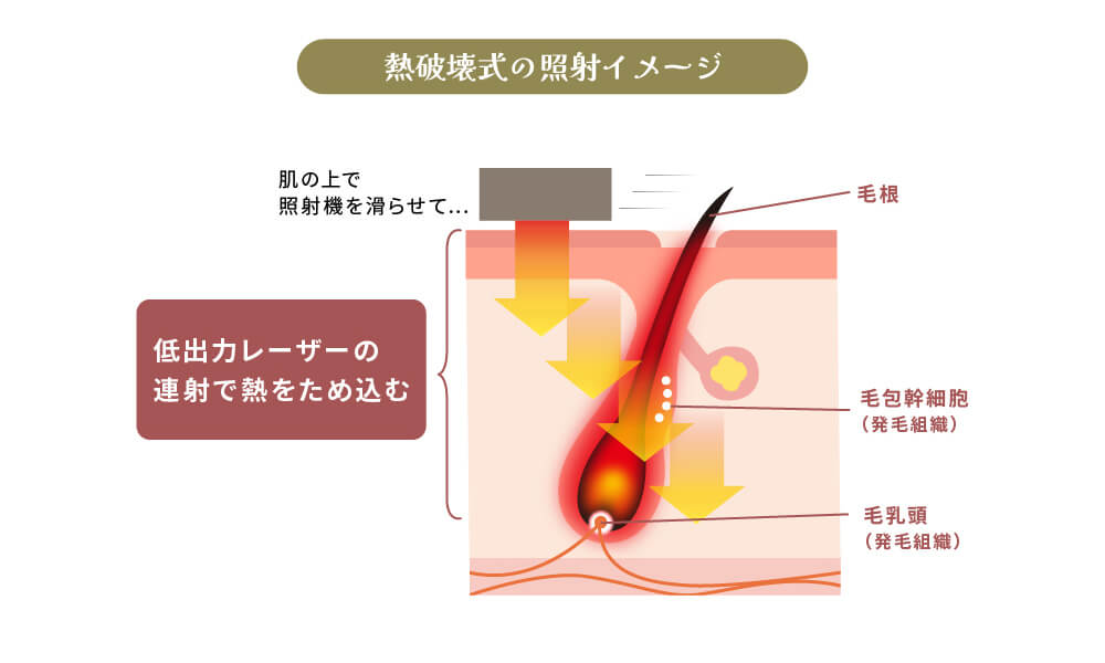 熱破壊式の照射イラスト