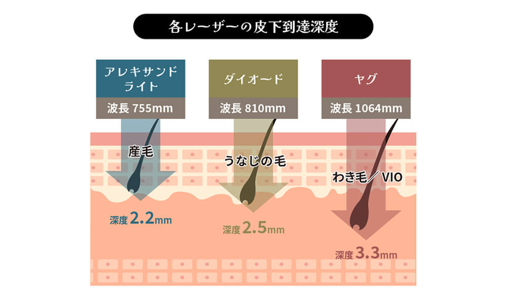 各レーザーの皮下到達深度のイラスト
