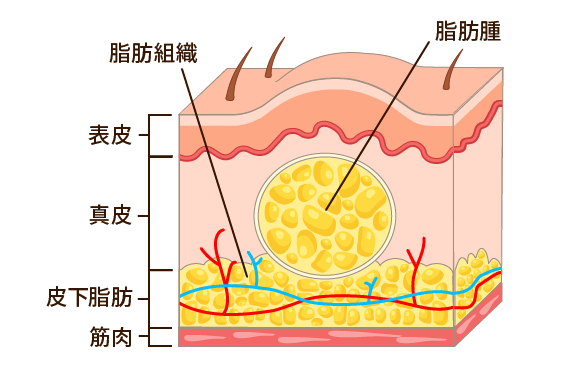神戸で脂肪腫の治療・手術の細かい治療イラスト