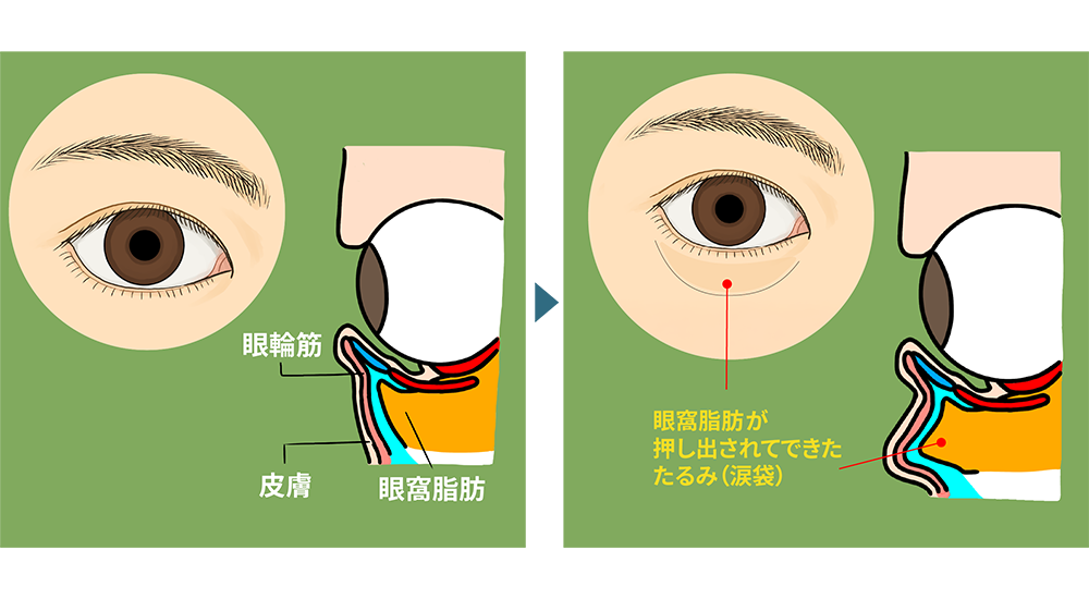 目の下のクマ・たるみ(ふくらみ)が出来るメカニズム図