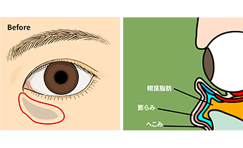 目の下のクマ・たるみ(ふくらみ)取りでの麻酔の様子