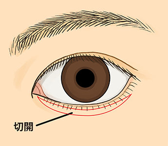 目の下のクマ・たるみ(ふくらみ)取りでの切開の様子