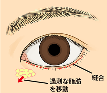 目の下のクマ・たるみ(ふくらみ)取りでの眼下脂肪調整の様子