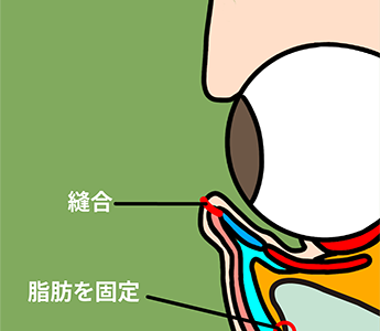 目の下のクマ・たるみ(ふくらみ)取りでの縫合後の様子