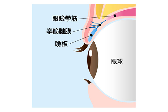 神戸で眼瞼下垂を保険適用で行う名医の仕組み説明イラスト