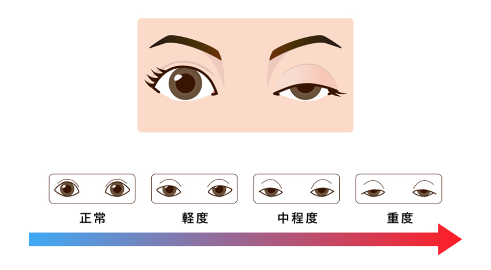 神戸で眼瞼下垂を保険適用で行う名医の症状進行イラスト