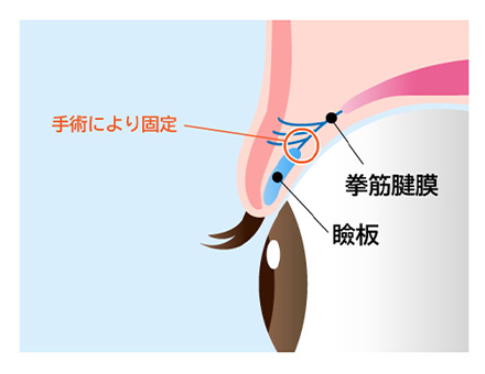 神戸で眼瞼下垂を保険適用で行う名医の手術イメージイラスト