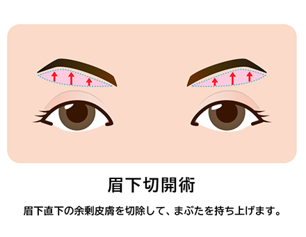 神戸で眼瞼下垂を保険適用で行う名医の眉下切開術イラスト