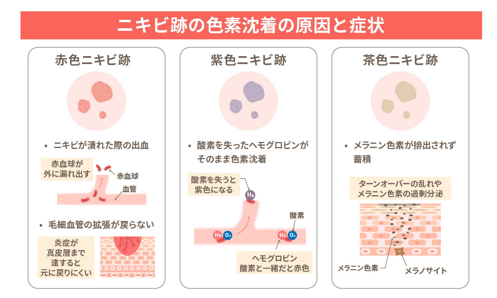 ニキビ跡の赤みの種類に関するイラスト