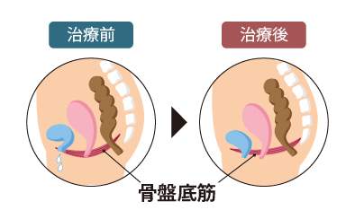 神戸で骨盤臓器の機能回復と排出機能の改善イメージ画像